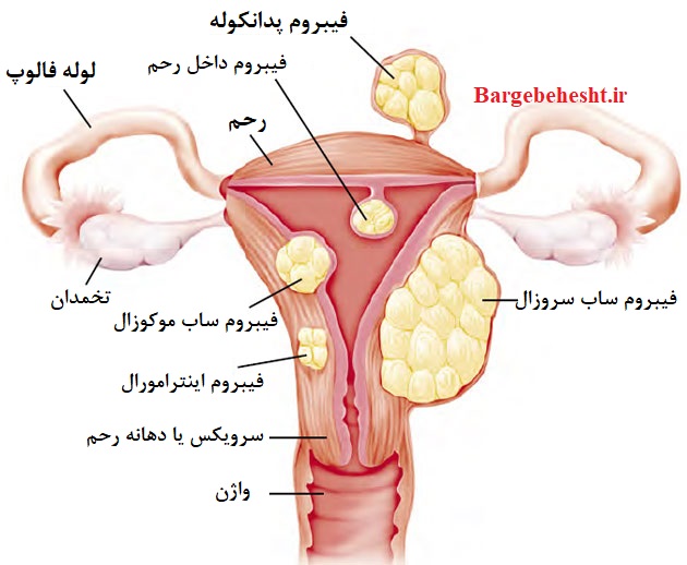 علل ایجاد فیبروم و میوم و راه های پیشگیری و درمان