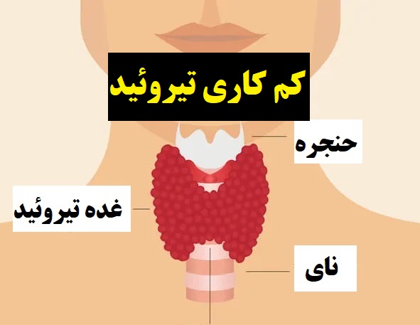 داروی گیاهی کم کاری تیروئید جایگزین لووتروکسین